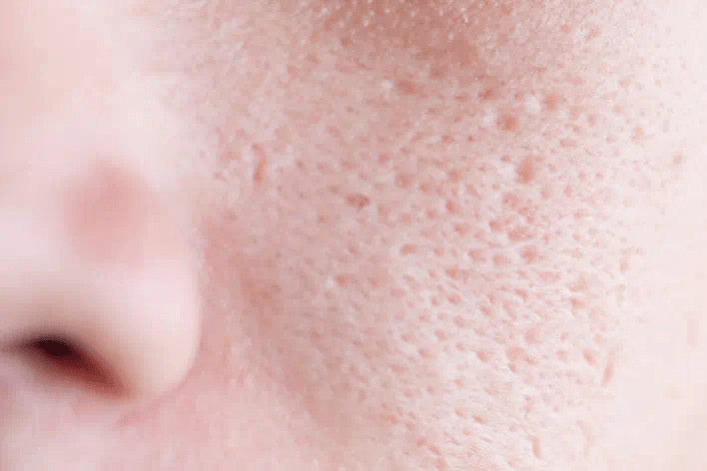 Clogged pores bumps top